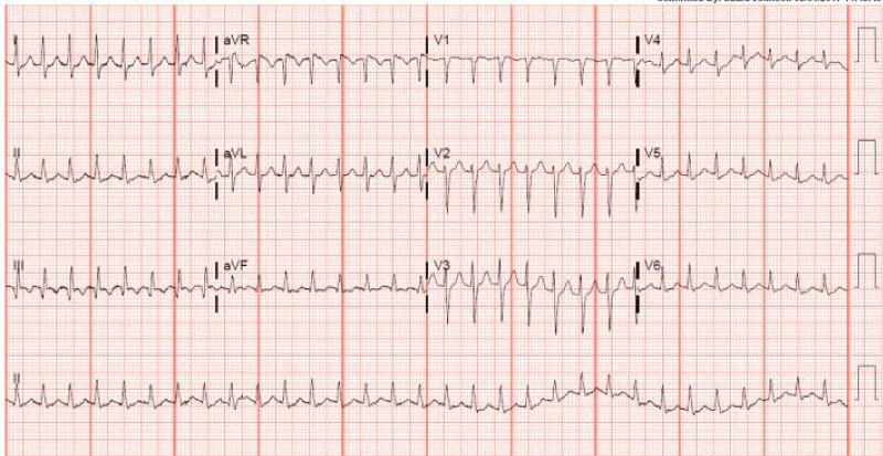 Supraventricular tachycardia with ventricular rate over 170.