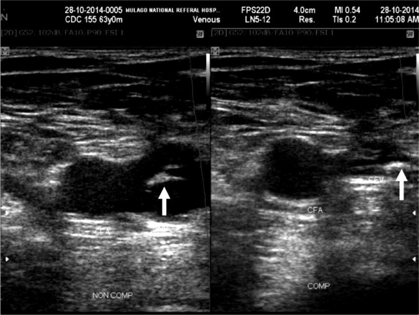 Duplex ultrasound in upper and lower limb deep venous thrombosis