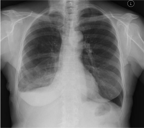 A Patient Diagnosed with POEMS Syndrome with Atypical Presentation