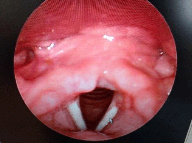 Muscle Tension Dysphonia