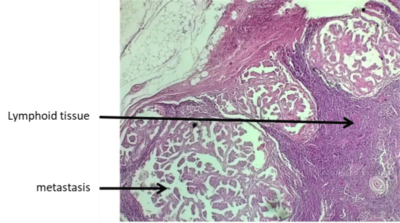 Cystic Cervical Lymph Nodes Metastasis Revealing A Papillary Carcinoma Of The Thyroid Gland A 