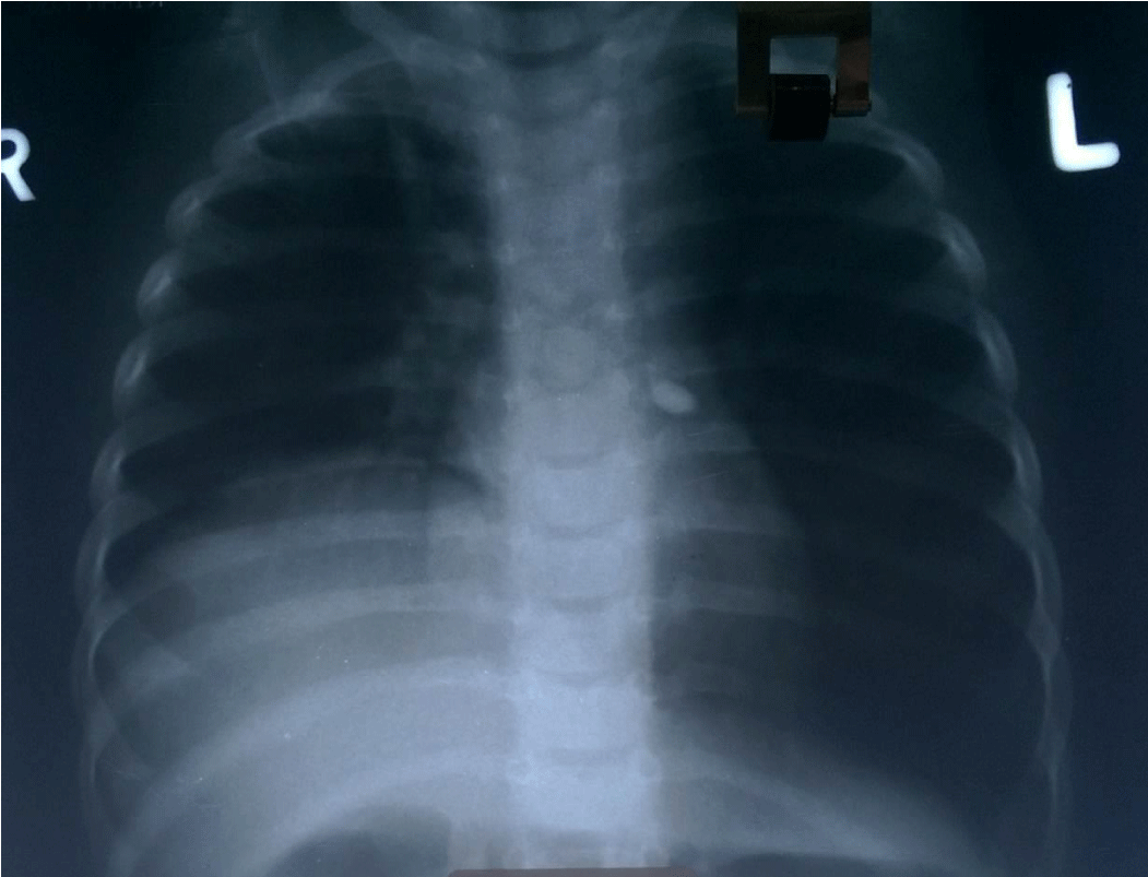 Use of ureteral catheter for under vision suctioning in rigid ...