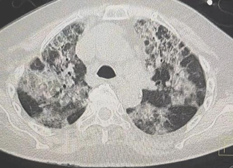 Pneumocystis jirovecii pneumonia in rheumatologic disease A case