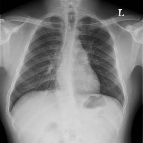 Syringomyelia Presenting As Obstructive Sleep Aponea