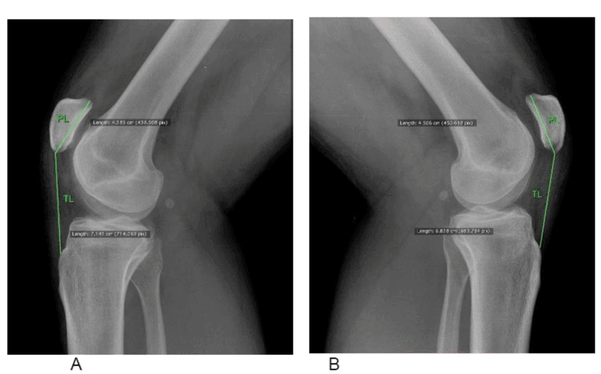 Patella Alta in a Patient with Recurrent Patellar Dislocation