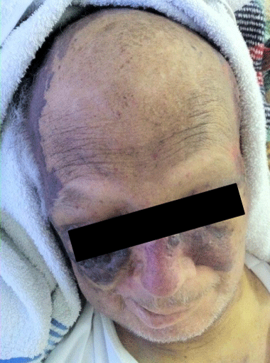 Angiosarcoma of the Scalp and Face: A Hard to Treat Tumor