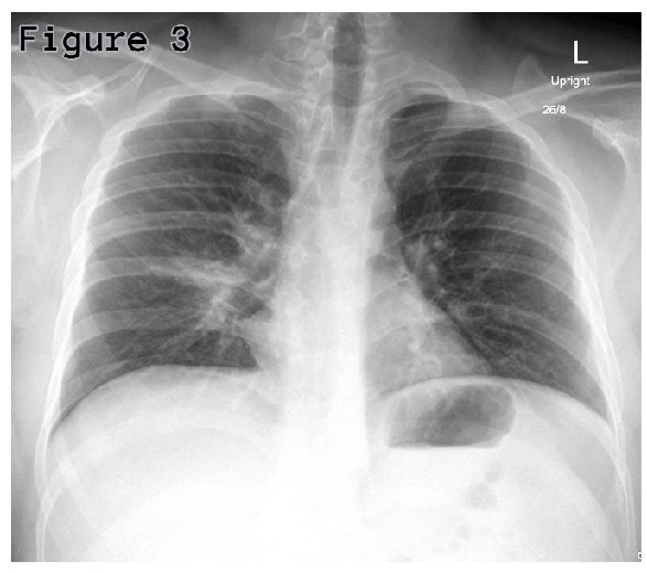 Mycoplasma pneumoniae-induced rash and mucositis: A rare extrapulmonary ...