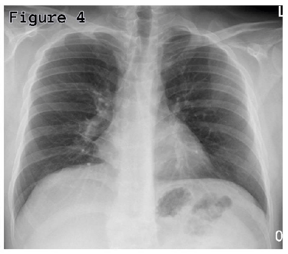 Mycoplasma pneumoniae-induced rash and mucositis: A rare extrapulmonary ...