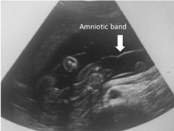 How We Monitor and Treat Amniotic Band Syndrome