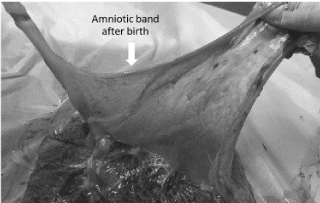 How We Monitor and Treat Amniotic Band Syndrome