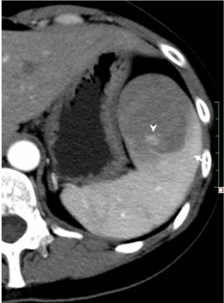 Sclerosing Angiomatoid Nodular Transformation of the Spleen (SANT): CT ...