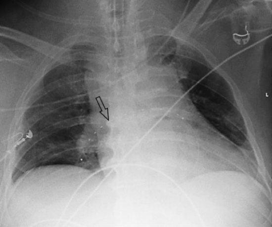 Combined Application of Percutaneous Extracorporeal Lung Assistance ...