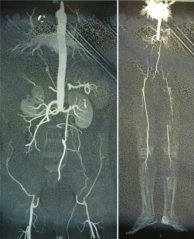 Descending thoracic aorta to bifemoral bypass grafting in Aortobiiliac ...