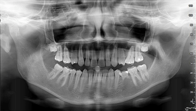 External root resorption of a permanent tooth. Case study