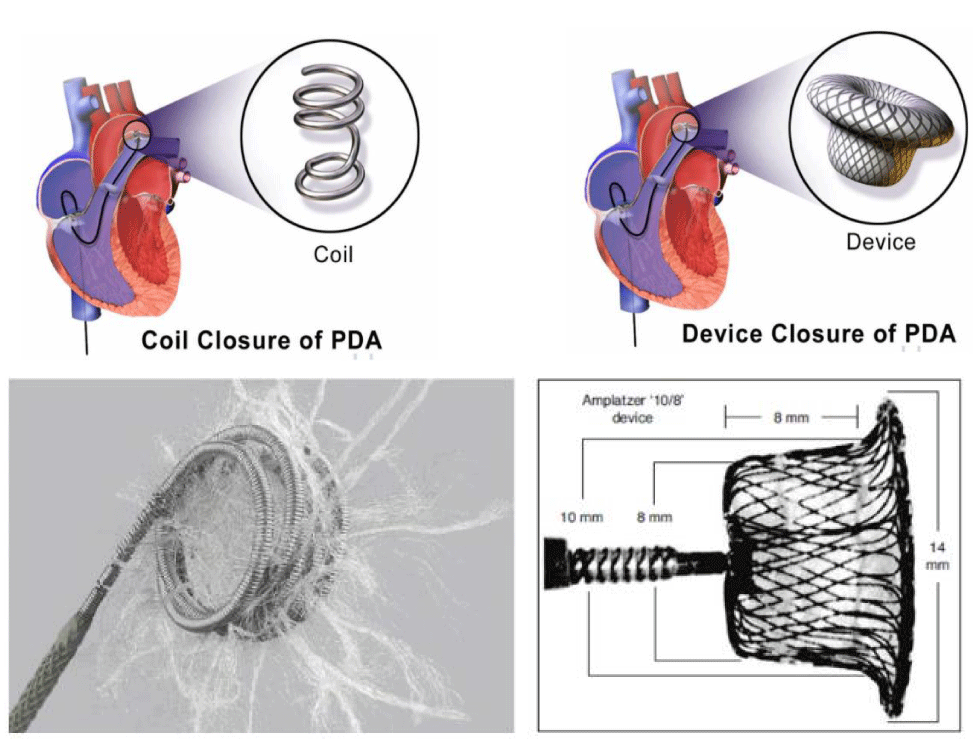 Percutaneous Patent Ductus Arteriosus (PDA) closure: When and how to ...