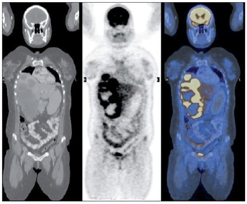 Пэт всего тела. Позитронно-эмиссионная томография метастазы. ПЭТ кт снимок метастазы. Позитронно-эмиссионная томография желудка.