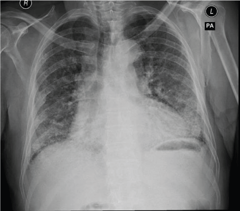 An atypical pulmonary presentation of Sjögren’s Syndrome